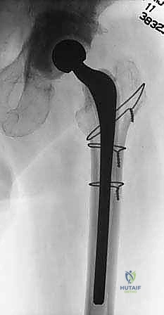 تحضير الفاصل الإسمنتي المحمل بالمضادات الحيوية
