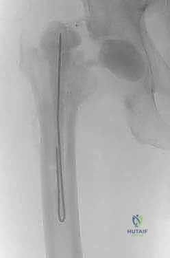 صورة توضيحية لـ ماستر كلاس: جراحة استبدال مفصل الورك على مرحلتين لعلاج التهاب المفصل المزمن بعد الجراحة باستخدام فاصل محمل بالمضادات الحيوية