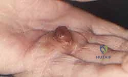 Illustration of tumors of the hand - Dr. Mohammed Hutaif