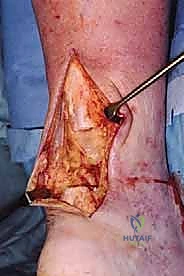 تأثير النسيج الندبي وانكماش الوتر في الحالات المزمنة