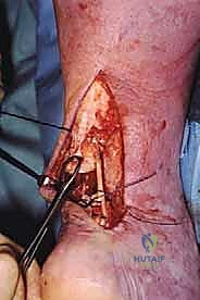 استخدام المنظار في جراحات الكاحل ووتر العرقوب