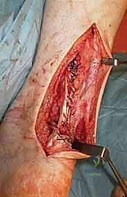 صورة توضيحية لـ إصلاح تمزق وتر العرقوب المزمن بالمنظار ونقل الأوتار: دليل شامل للمرضى مع الأستاذ الدكتور محمد هطيف