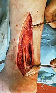 صورة توضيحية لـ إصلاح تمزق وتر العرقوب المزمن بالمنظار ونقل الأوتار: دليل شامل للمرضى مع الأستاذ الدكتور محمد هطيف