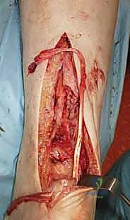 صورة توضيحية لـ إصلاح تمزق وتر العرقوب المزمن بالمنظار ونقل الأوتار: دليل شامل للمرضى مع الأستاذ الدكتور محمد هطيف