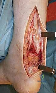 خطوات الجراحة الدقيقة لإصلاح وتر العرقوب