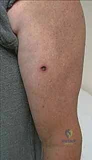 Mastering Excision and Reconstruction of Hand Malignancies: SCC & Melanoma