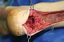 تحضير الطعوم الخيفية لإعادة بناء وتر أخيل