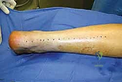 تشخيص تمزق وتر أخيل المزمن بالرنين المغناطيسي