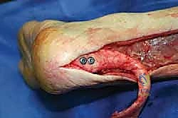 تثبيت الطعم الخيفي في عظم الكعب