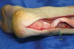 الخطوات الجراحية الدقيقة لإصلاح وتر أخيل