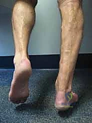 Allograft Reconstruction for Chronic Achilles Rupture: An Intraoperative Masterclass