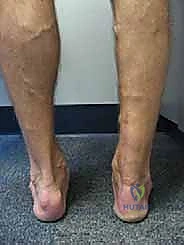 تمزق وتر أخيل المزمن: دليل شامل للعلاج بالطعوم الخيفية مع الأستاذ الدكتور محمد هطيف