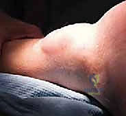 نهج الدكتور محمد هطيف في الجراحة الميكروسكوبية لوتر العرقوب