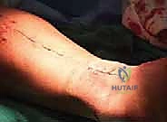 Surgical technique step for Soft Tissue Expansion in RevisionComplex Achilles Tendon Reconstruction TECHNIQUES