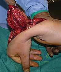 Illustration of tumor of bone - Dr. Mohammed Hutaif