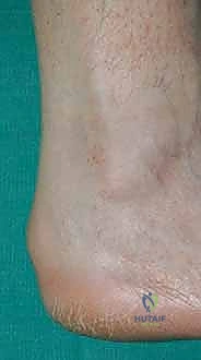 Illustration of insertional achilles tendinopathy - Dr. Mohammed Hutaif