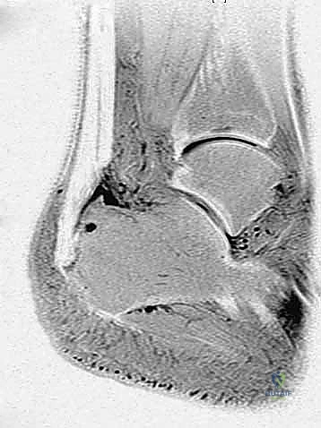 جراحة وتر أخيل في صنعاء