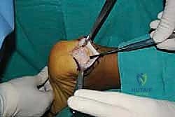 فصل الوتر للوصول للعظم