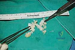 التخطيط الجراحي لعملية وتر أخيل