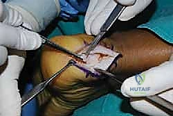 الشق الجراحي الدقيق