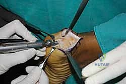 التخلص من ألم وتر أخيل الارتكازي: دليل شامل للعلاج الجراحي وغير الجراحي