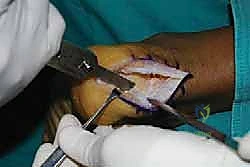 صور الرنين المغناطيسي لوتر أخيل