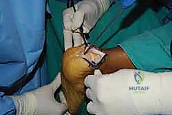 إزالة الجراب الملتهب