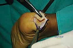 صورة توضيحية لـ التخلص من ألم وتر أخيل الارتكازي: دليل شامل للعلاج الجراحي وغير الجراحي