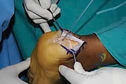 تنظيف التكلسات من الوتر