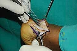 صورة توضيحية لـ التخلص من ألم وتر أخيل الارتكازي: دليل شامل للعلاج الجراحي وغير الجراحي