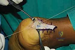 صورة طبية: التخلص من ألم وتر أخيل الارتكازي: دليل شامل للعلاج الجراحي وغير الجراحي