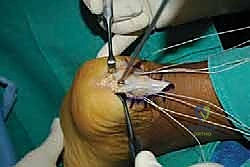 صورة طبية: التخلص من ألم وتر أخيل الارتكازي: دليل شامل للعلاج الجراحي وغير الجراحي