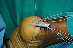 صورة طبية: التخلص من ألم وتر أخيل الارتكازي: دليل شامل للعلاج الجراحي وغير الجراحي