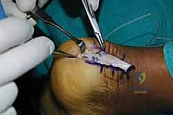 صورة طبية: التخلص من ألم وتر أخيل الارتكازي: دليل شامل للعلاج الجراحي وغير الجراحي