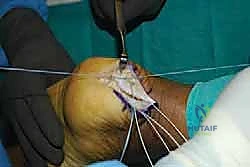 صورة طبية: التخلص من ألم وتر أخيل الارتكازي: دليل شامل للعلاج الجراحي وغير الجراحي