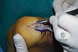 صورة طبية: التخلص من ألم وتر أخيل الارتكازي: دليل شامل للعلاج الجراحي وغير الجراحي