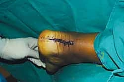 صورة طبية: التخلص من ألم وتر أخيل الارتكازي: دليل شامل للعلاج الجراحي وغير الجراحي