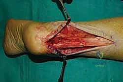 صورة طبية: التخلص من ألم وتر أخيل الارتكازي: دليل شامل للعلاج الجراحي وغير الجراحي