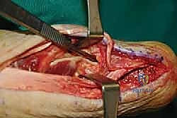 صورة طبية: التخلص من ألم وتر أخيل الارتكازي: دليل شامل للعلاج الجراحي وغير الجراحي