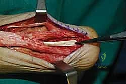 صورة طبية: التخلص من ألم وتر أخيل الارتكازي: دليل شامل للعلاج الجراحي وغير الجراحي