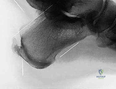 التشريح الدقيق لوتر أخيل وعظم الكعب وحماية العصب السطحي