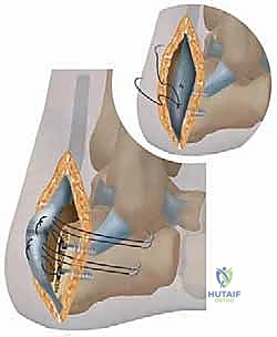 صورة توضيحية لـ النهج الجانبي لعلاج التهاب وتر أخيل التكلسي: حل شامل لآلام الكعب المزمنة في صنعاء
