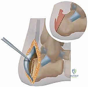 صورة توضيحية لـ النهج الجانبي لعلاج التهاب وتر أخيل التكلسي: حل شامل لآلام الكعب المزمنة في صنعاء