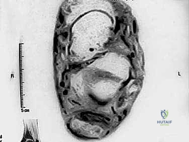 استئصال النتوء العظمي في الكعب
