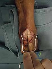 تحضير النفق العظمي في الكعب