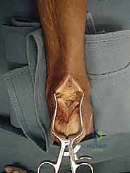 تثبيت وتر FHL في النفق العظمي