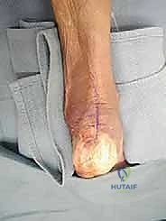 إعادة بناء وتر أخيل والإغلاق