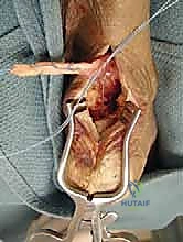 صورة توضيحية لـ علاج اعتلال وتر أخيل الإدخالي المزمن: دليل شامل لتعزيز الوتر باستخدام وتر FHL مع الأستاذ الدكتور محمد هطيف