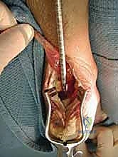 تشريح وتر أخيل والقدم