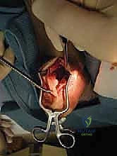 صورة توضيحية لـ علاج اعتلال وتر أخيل الإدخالي المزمن